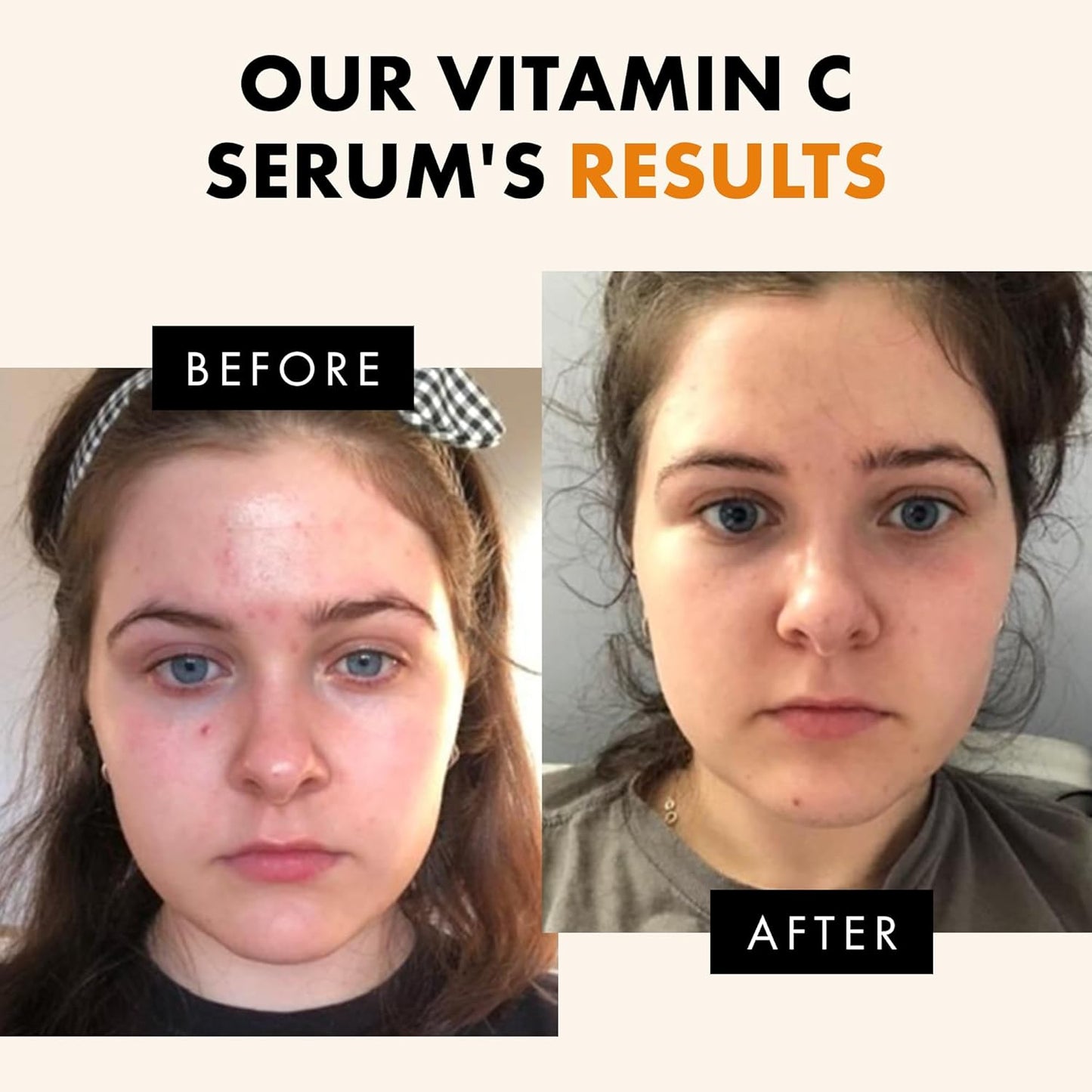 Vitamin C Face Serum – Brightening Anti-Aging Formula with Hyaluronic Acid & Vitamin E
