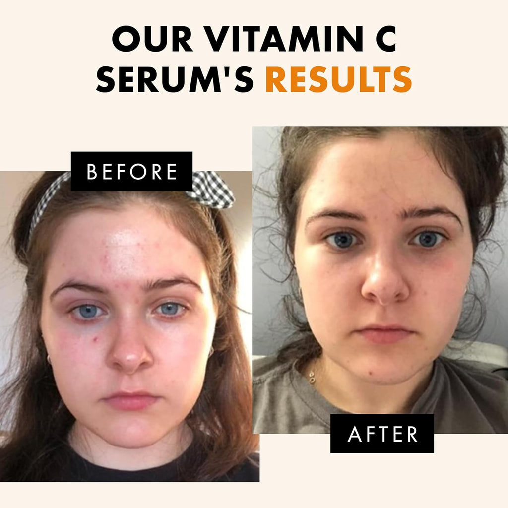 Vitamin C Face Serum – Brightening Anti-Aging Formula with Hyaluronic Acid & Vitamin E